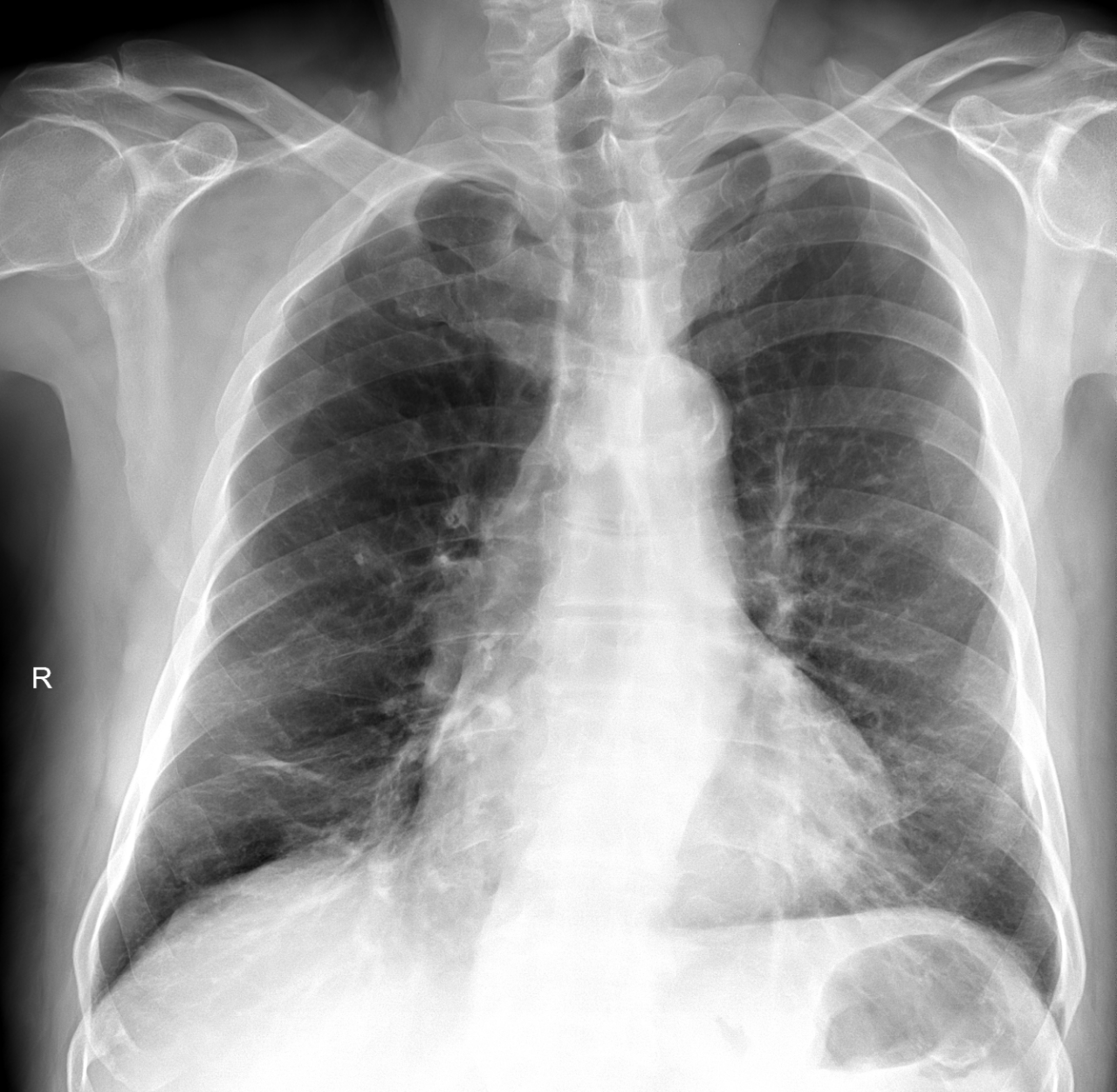 壹生资讯-常见4种肺结节影像，轻松识别！
